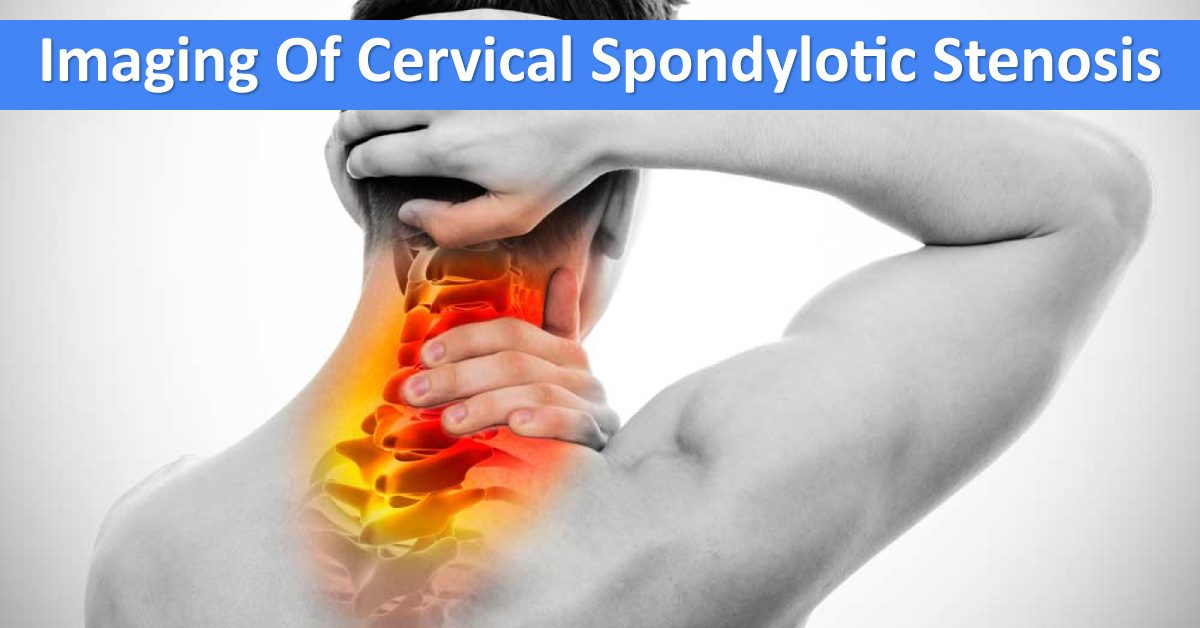Imaging Modalities For Cervical Spondylotic Stenosis