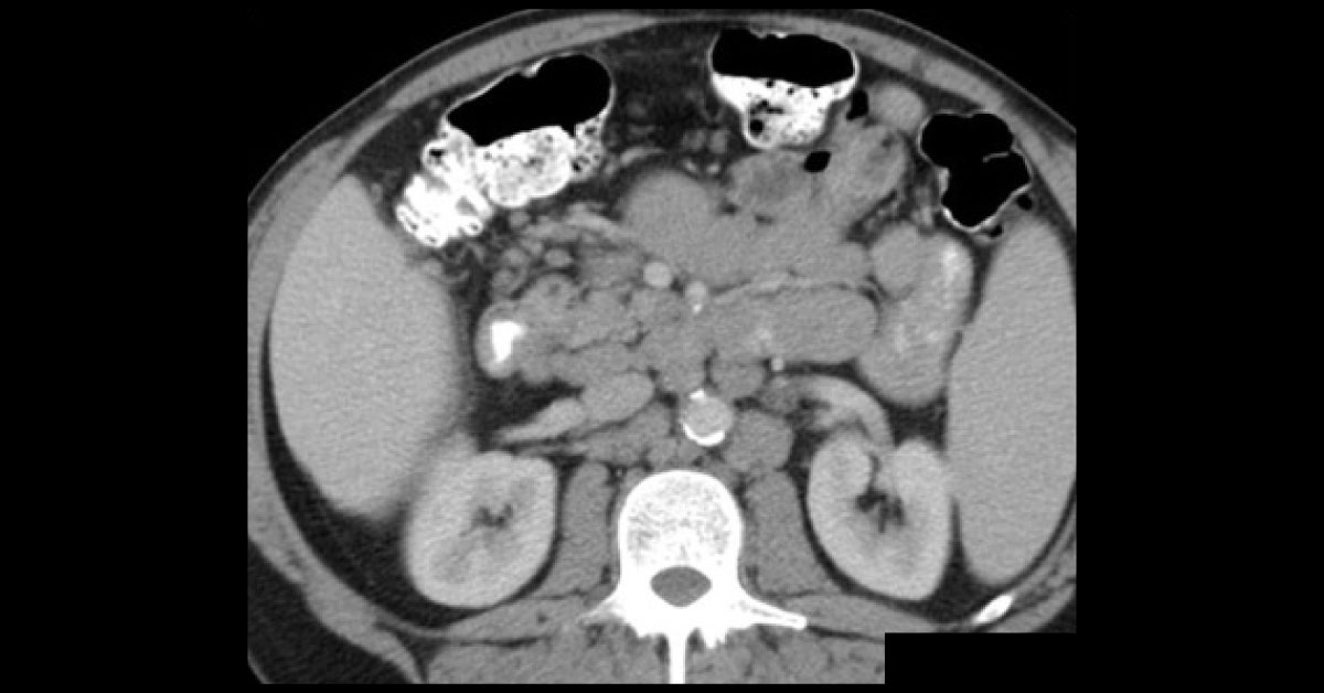 Diagnose The Abdominal Fullness