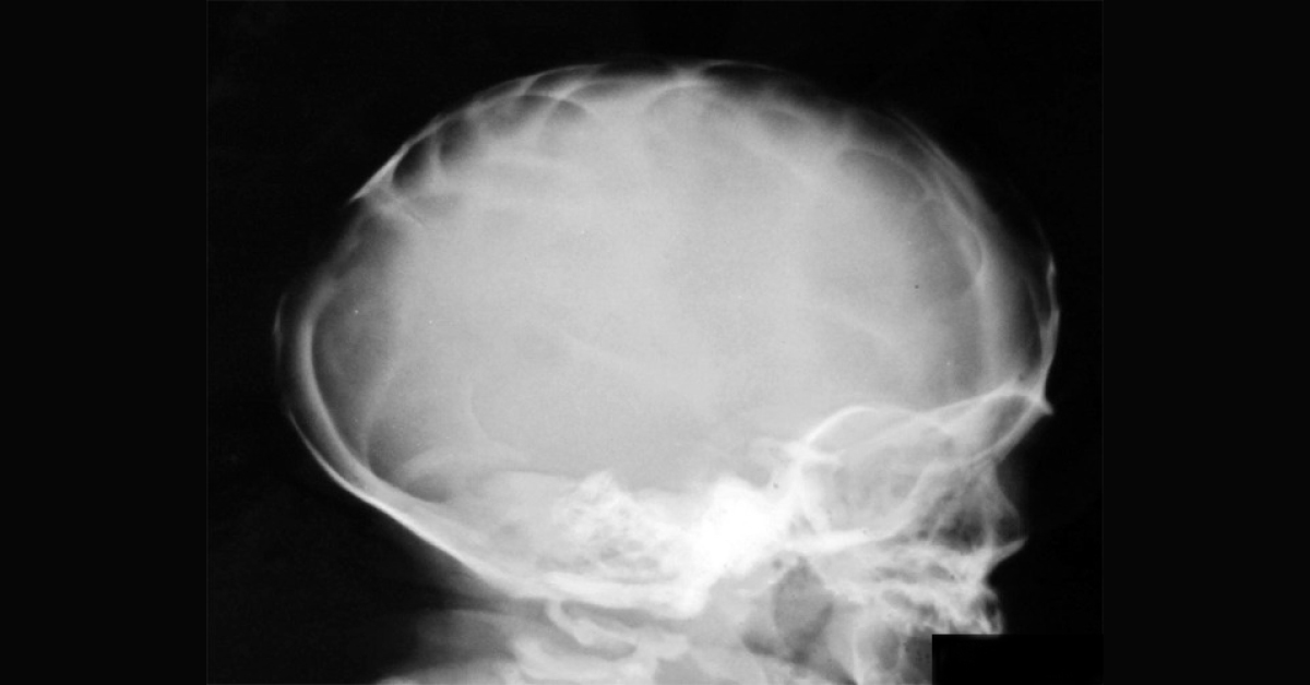 Swallowing Difficulties In Infant