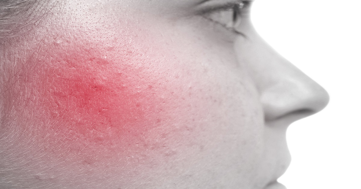 Hormonal Therapy For Acne In Women