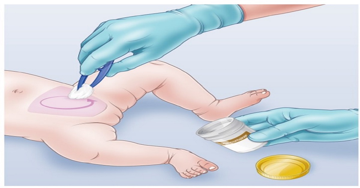 Faster Clean Catch Urine Collection From Infants