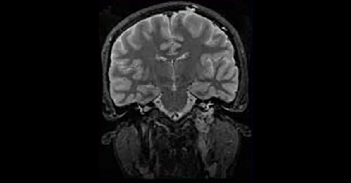 A Case Of Pulsatile Tinnitus