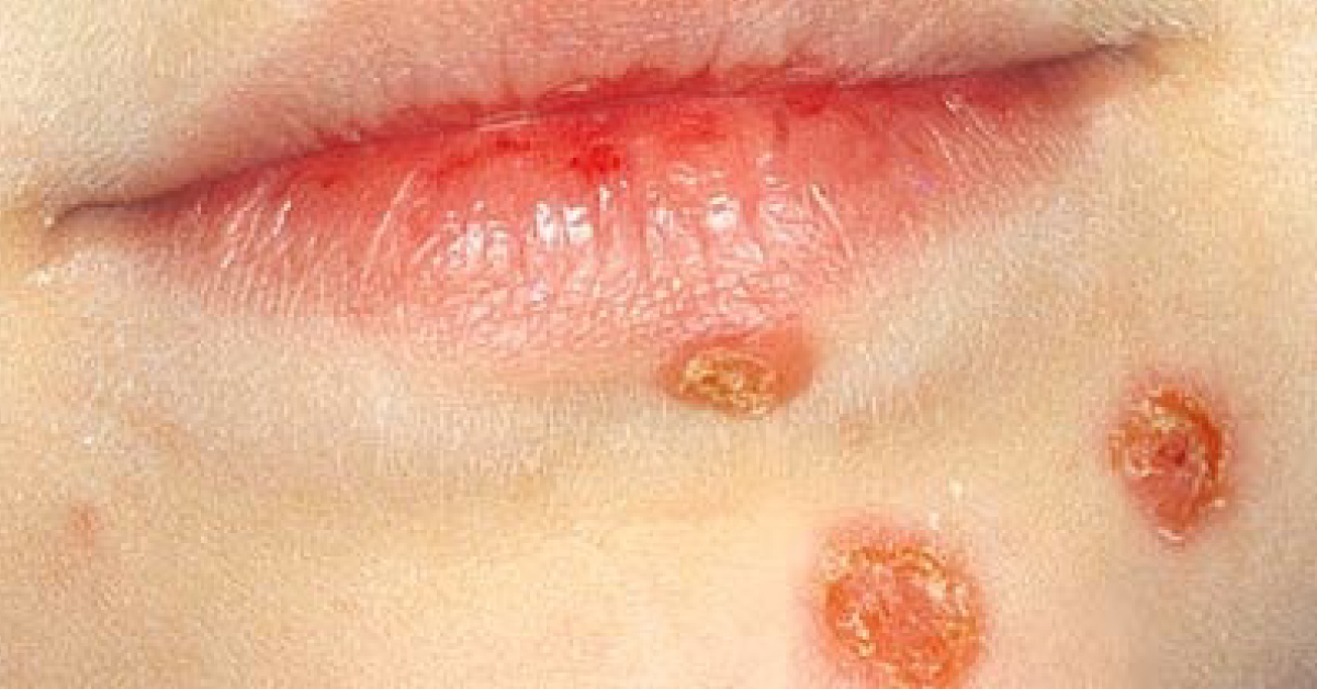 Identify The Dermal Condition