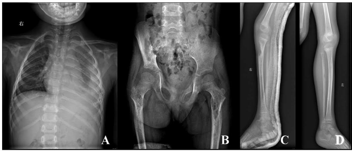 Vanishing Bone Disease, A Rare Entity