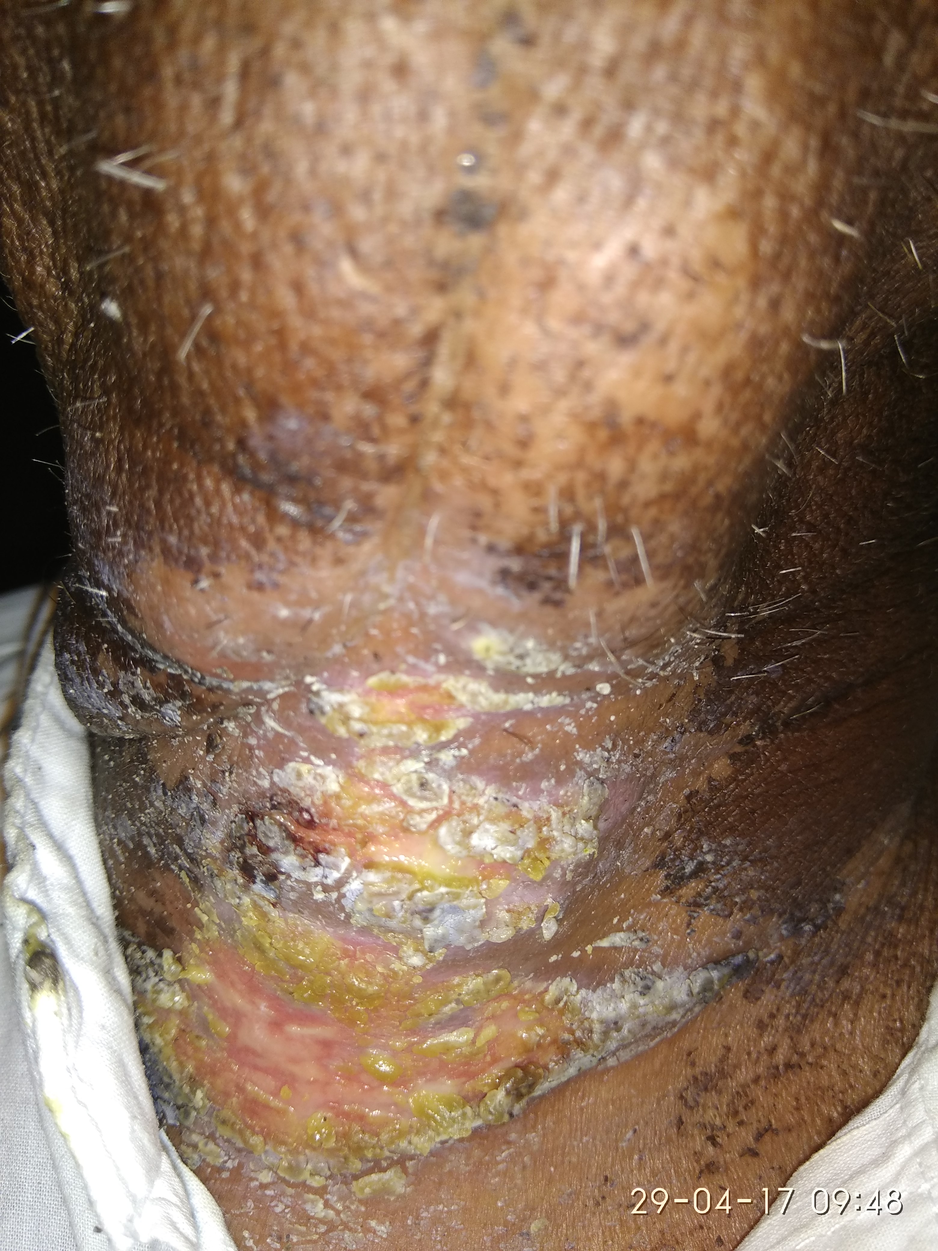 Management Of Lesion On Neck With Oral Cancer History