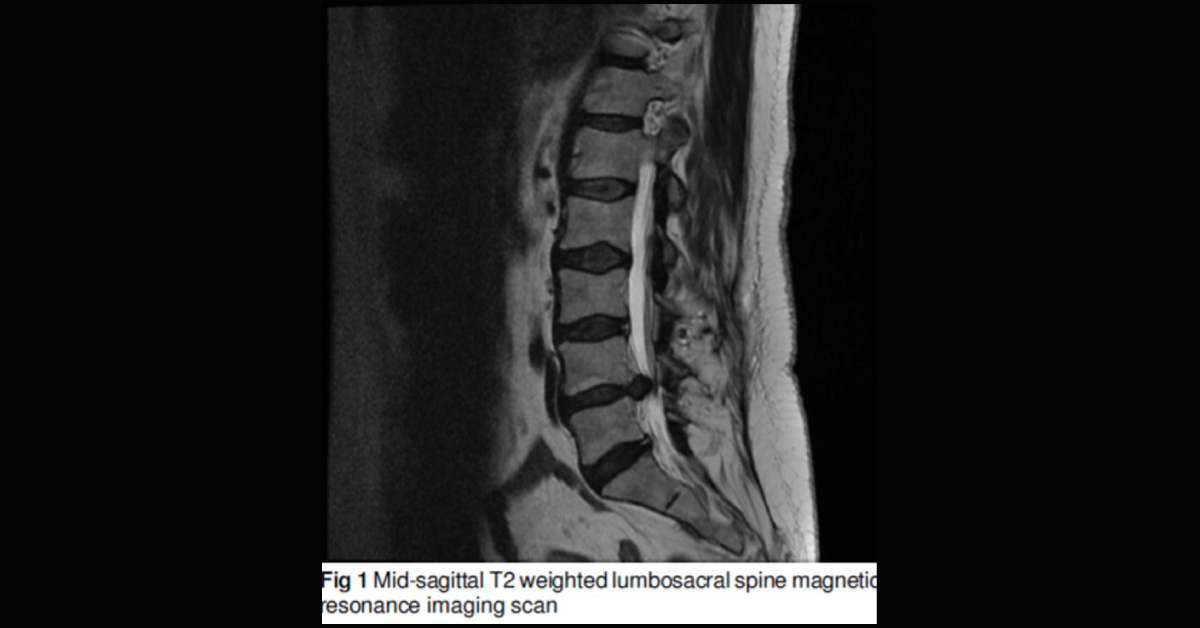 Case of A Lower Back Pain