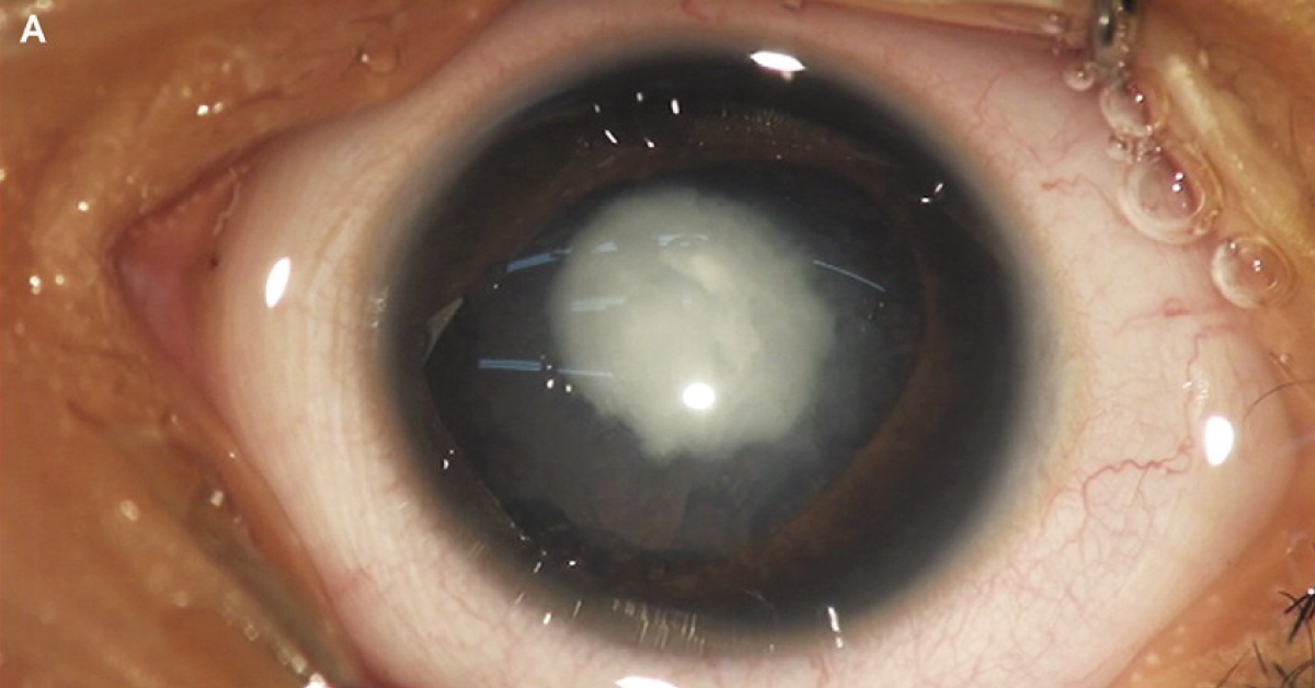 A Toddler With White Opacities In Both Eyes