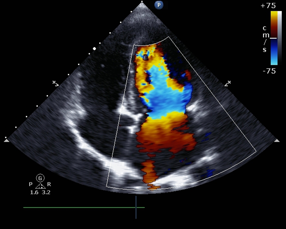 Pathophysiology Of Mitral Stenosis