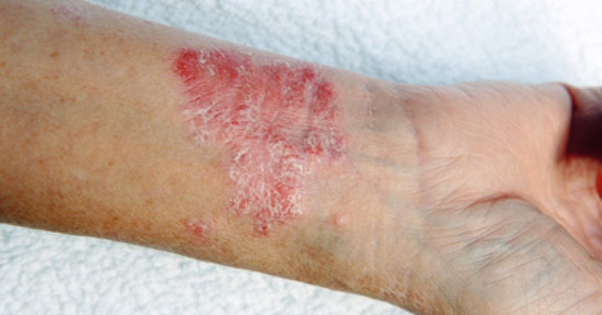 Scabies Infestation, An Overview