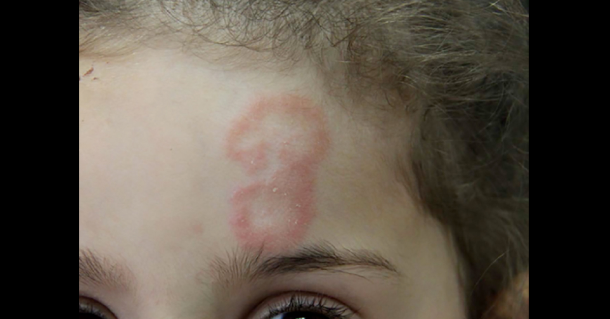 What Is This Dermal Condition