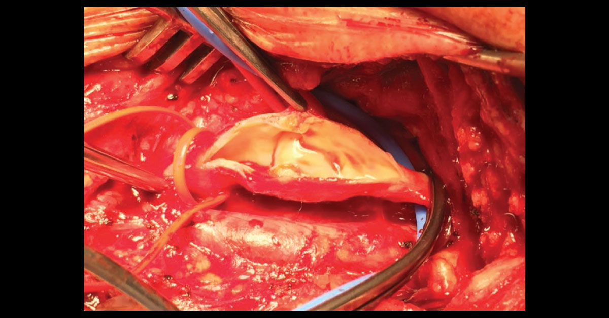 Asymptomatic Extracranial Carotid Stenosis Management By  Carotid Artery Stent Placement