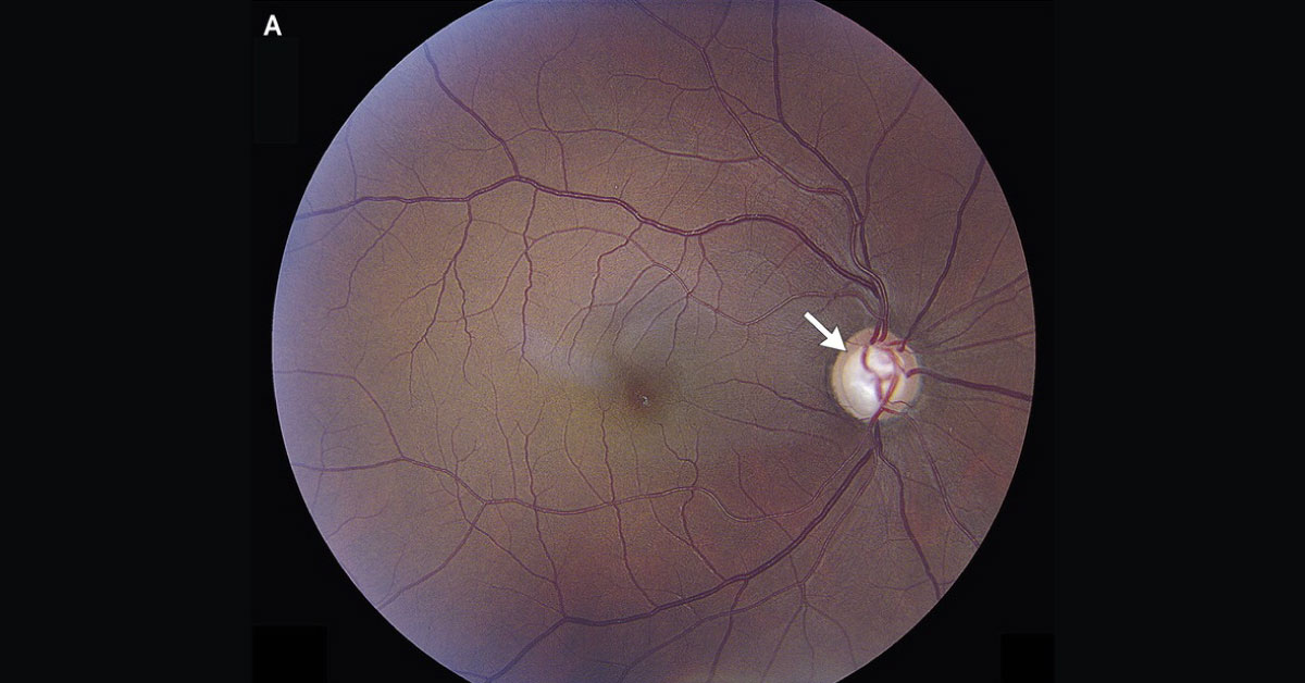 Sudden Loss Of Vision In Hypertensive Man