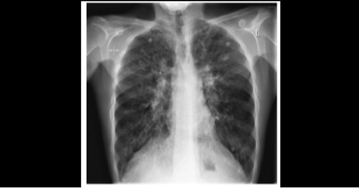 Diagnose From The Chest X-Ray