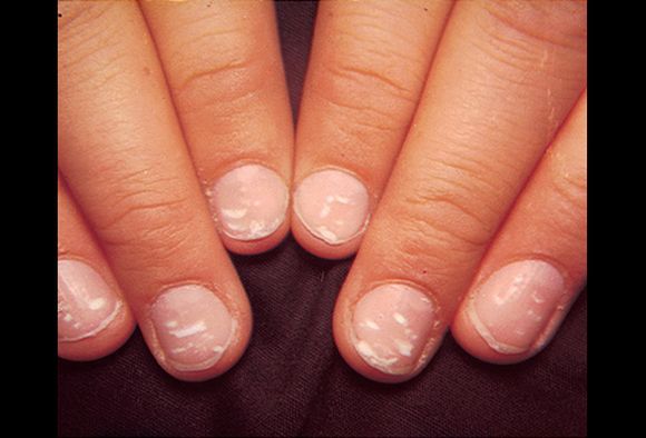 White Spots On Nails, Causes and Treatment