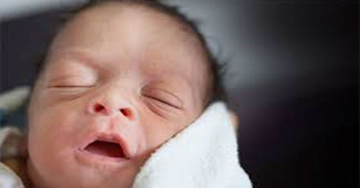 Chicken Pox, Need For Prevention And Treatment Popularisation