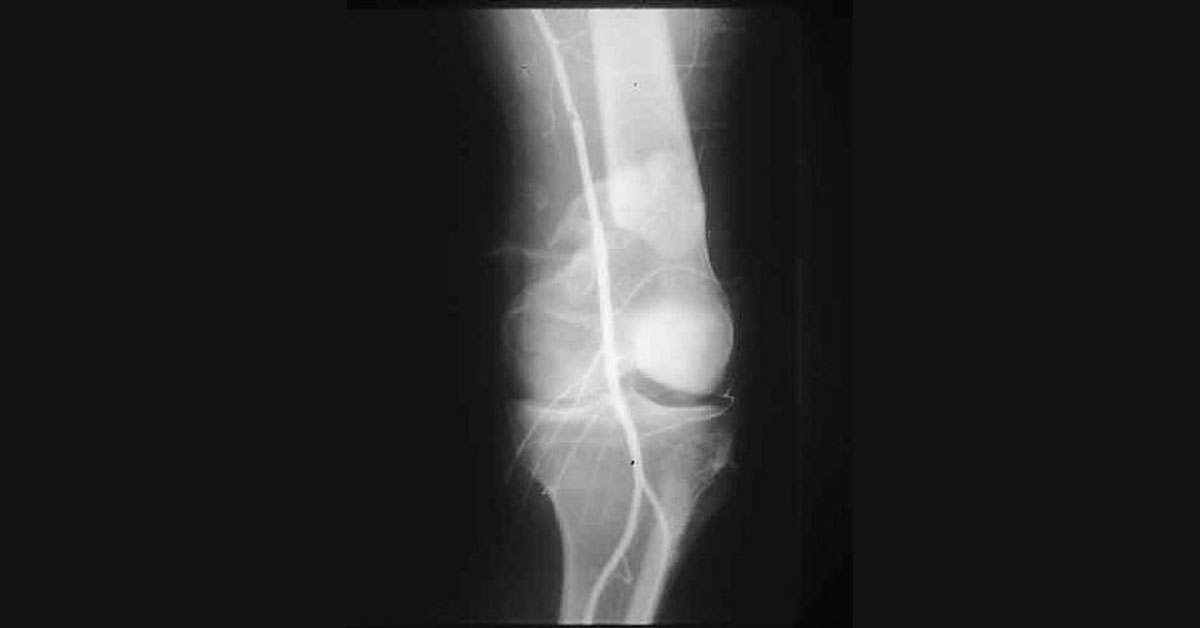 Management Of Vascular Injury With Orthopaedic Trauma