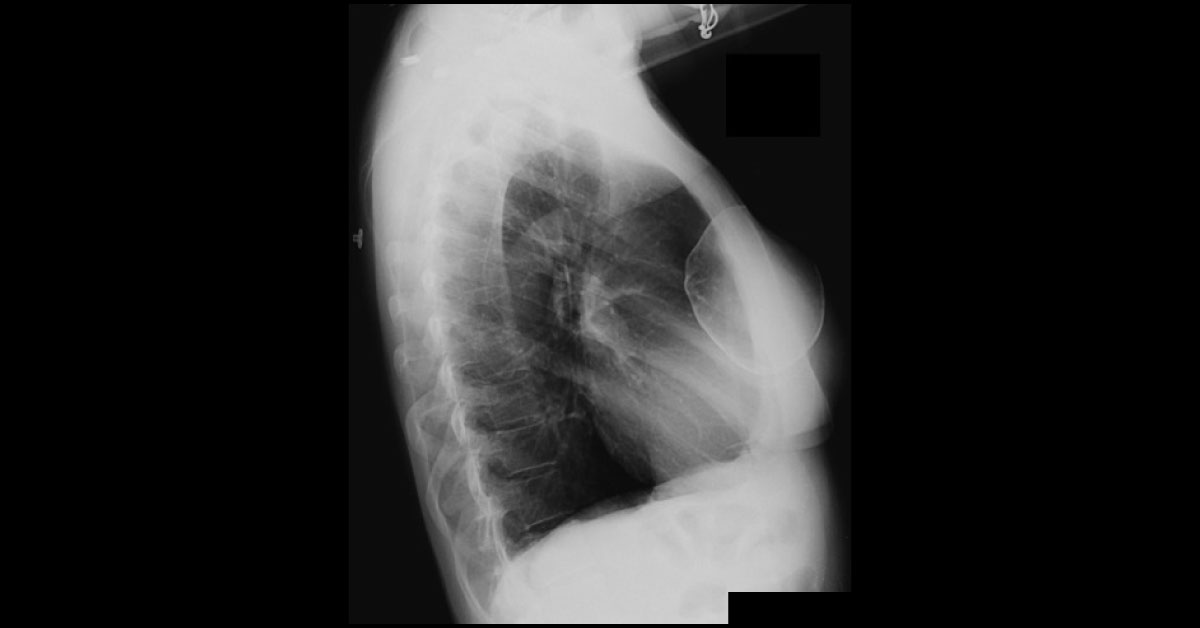 Diagnose The Abnormality From The Chest Radiograph