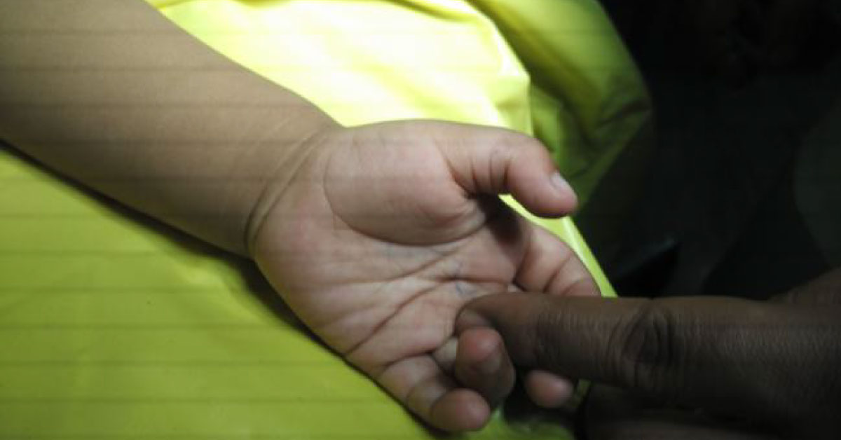 Overview Of Trigger Thumb Or Finger