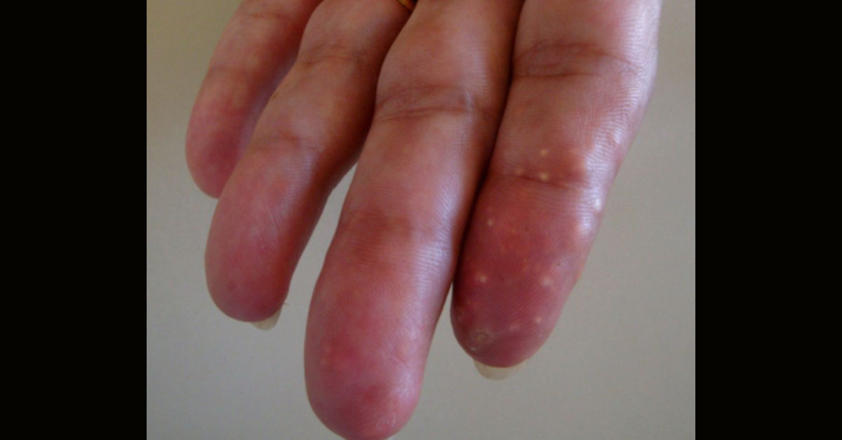 Whitish Papules On The Hands