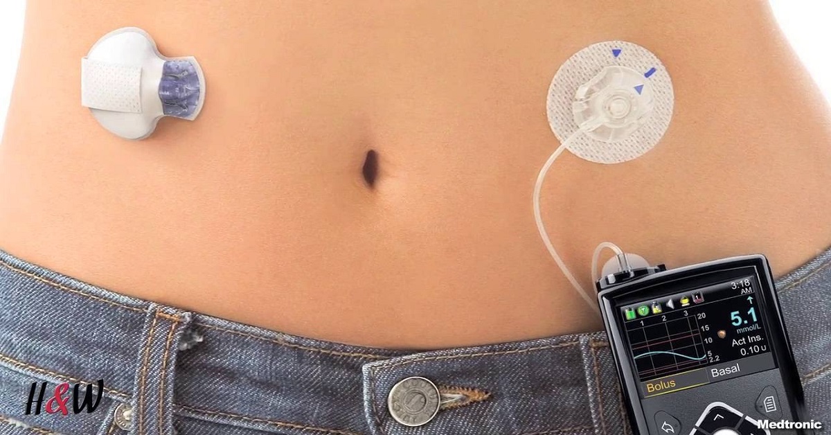 Artificial Pancreas, Promises And Challenges