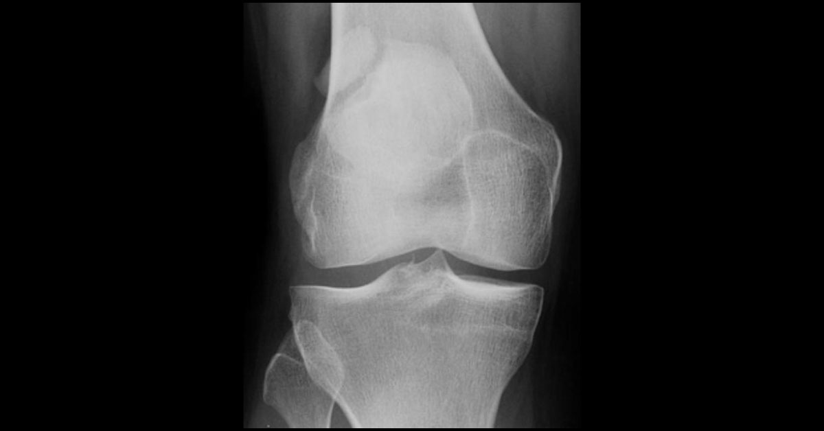A Boy Complaining Knee Pain