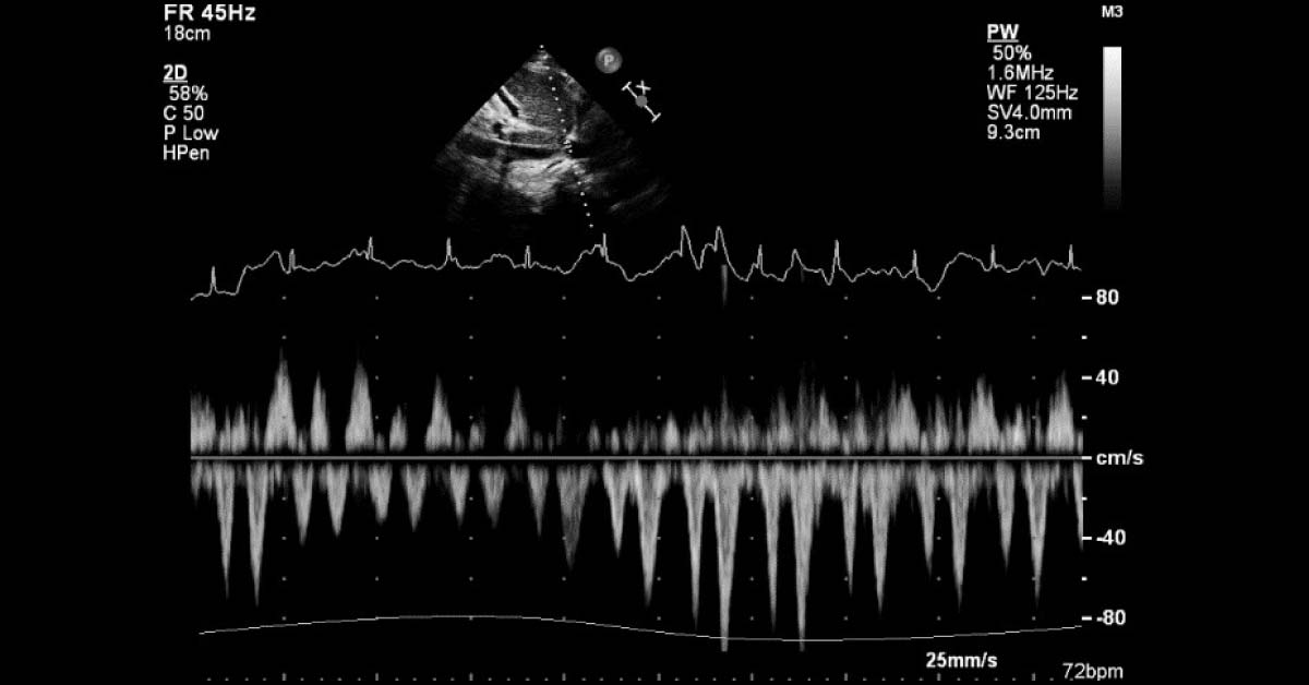 A Patient with Renal Failure and Fluid Overload