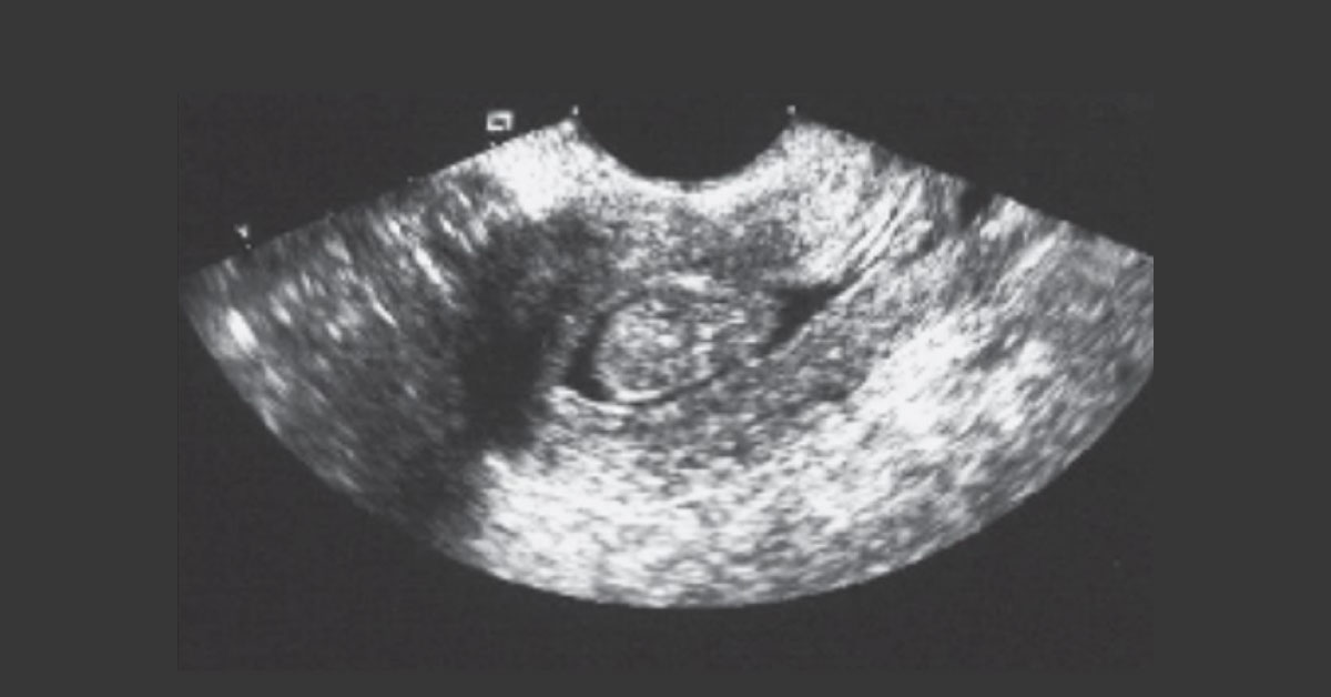 Case Of Intermenstrual Bleeding