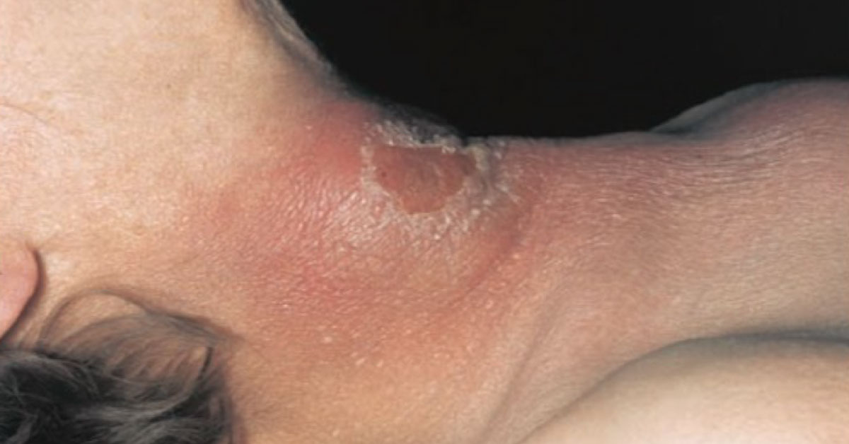 Identify The Tender Lesion On Neck