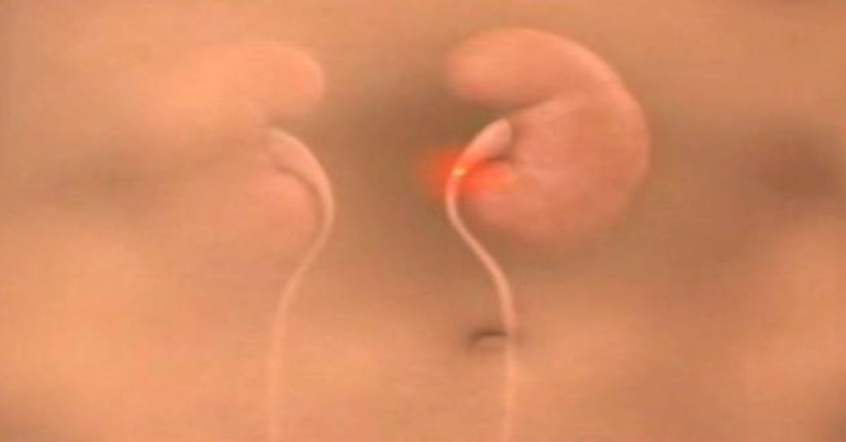 Renal Stones Prevention, Easy Method