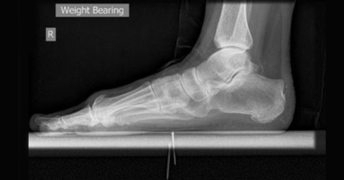 Identify This Condition Of Great Stiff Toe