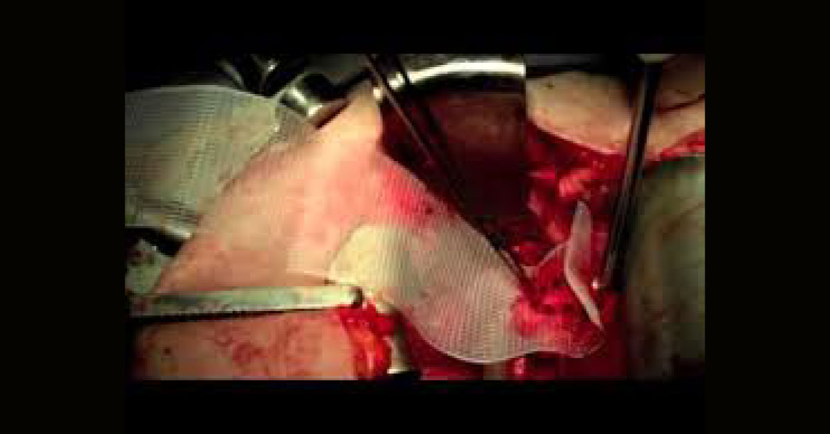 Sacrocolpopexy Using Mesh For Vaginal Vault Prolapse Repair