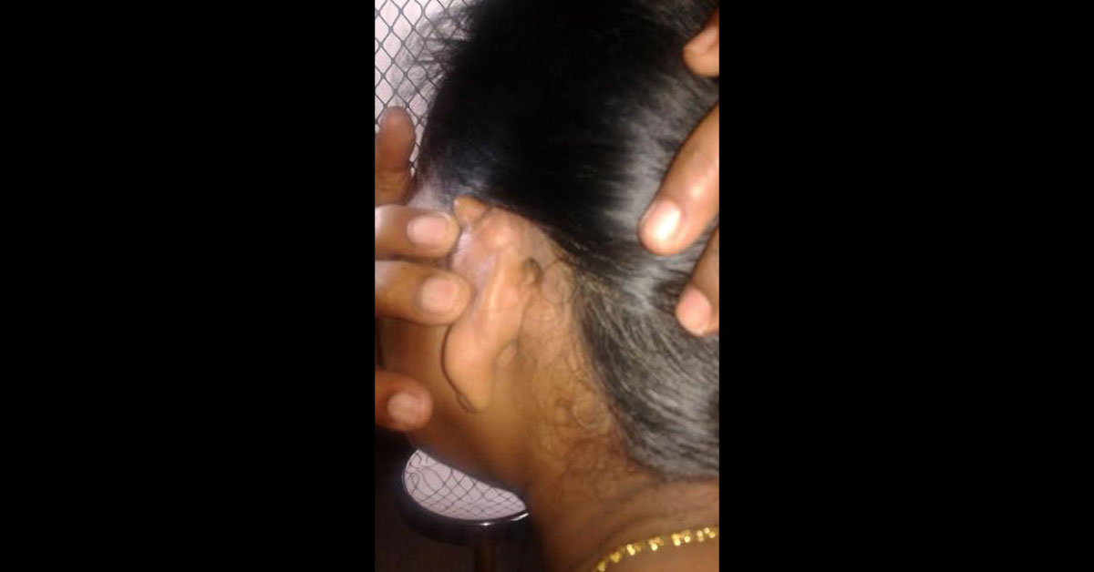 A Case Of BL CSOM