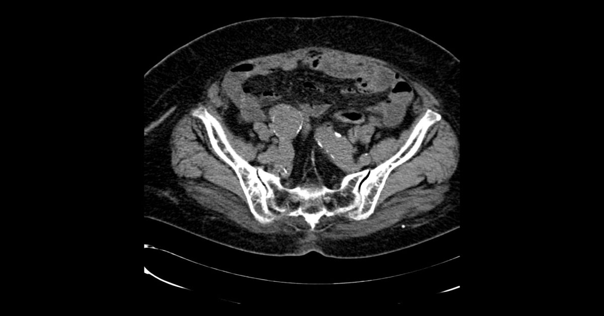 Identify This Abdominal Complication