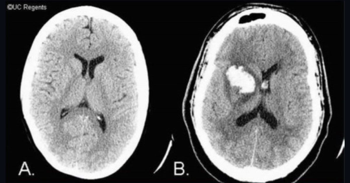Critical Case Of A Severe Headache