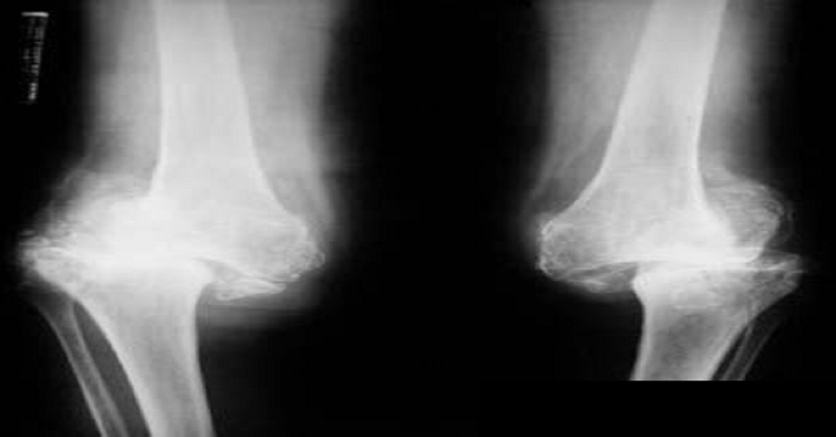 Conclude The Condition From Radiograph