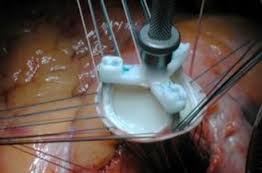 Sutureless Aortic Valve Replacement For Aortic Stenosis