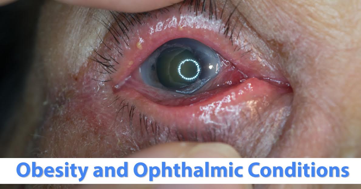 Obesity And Eye Diseases, What Is The Connection