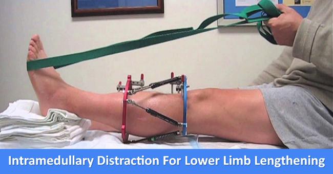 Intramedullary Distraction For Lower Limb Lengthening