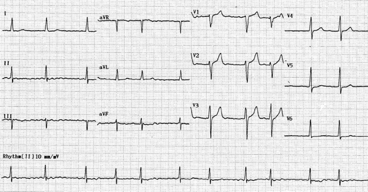 An Elderly Patient with Chest Pain