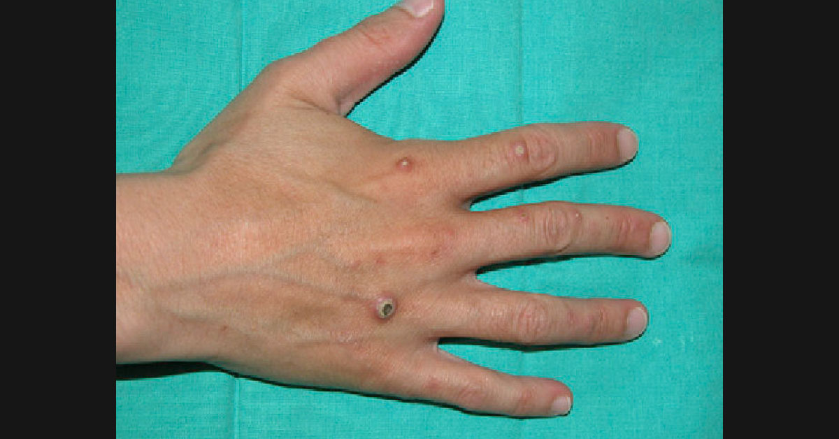 Identify Lesions On Dorsum Of Hands