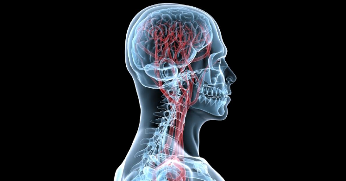 Risk Factors For Cervical Artery Dissection