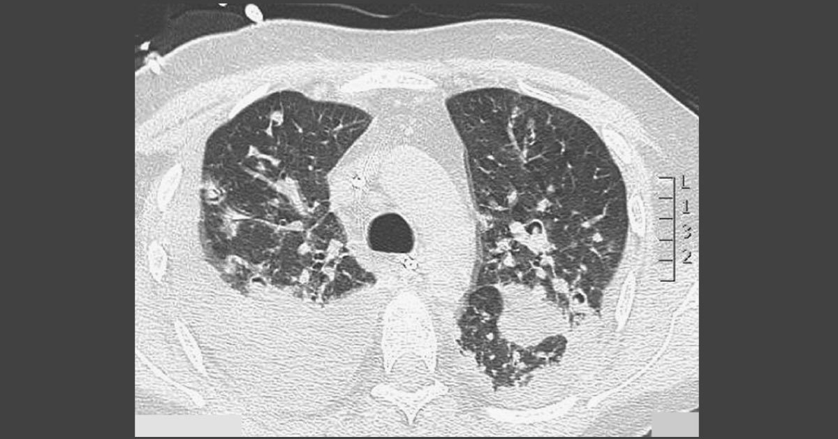 Identify The Complication From CT