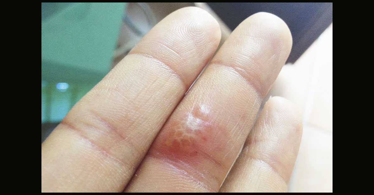 Presence Of Erythematous, Confluent Vesicles On The Finger