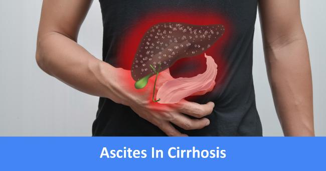 Ascites In Cirrhosis Management: BSG Guidelines 2006