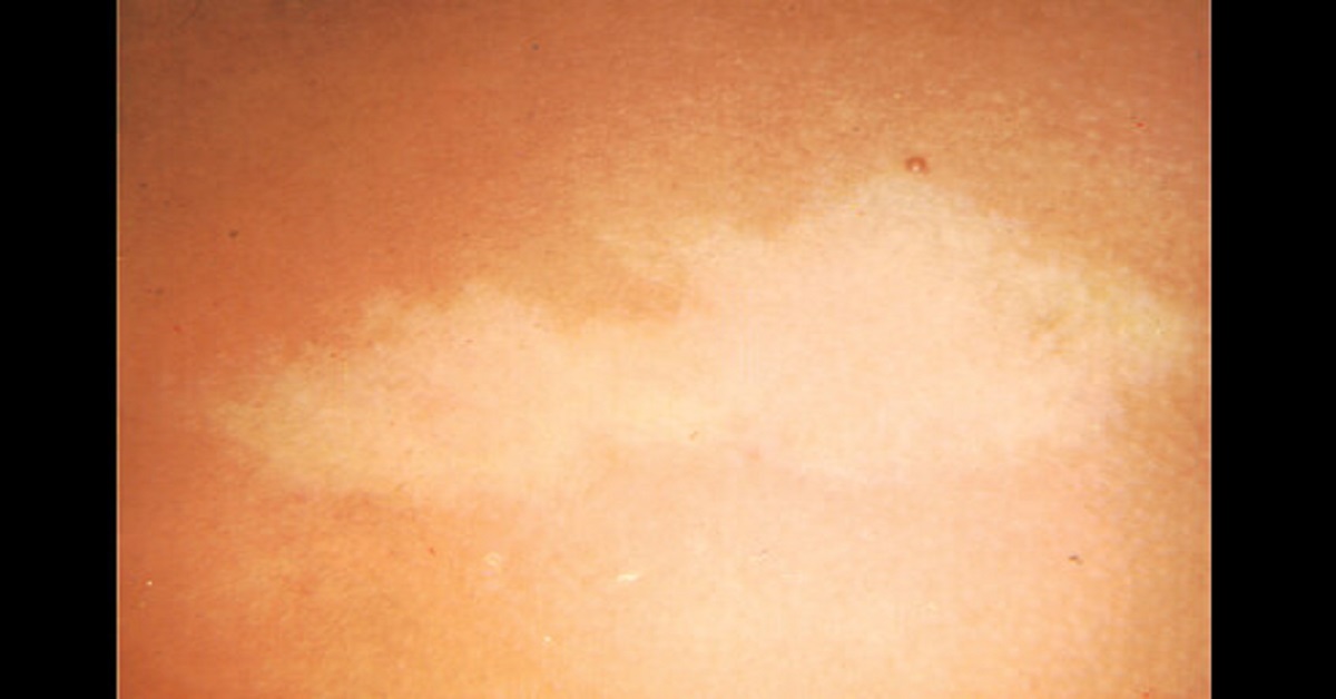 Achromic Naevus, An Overview