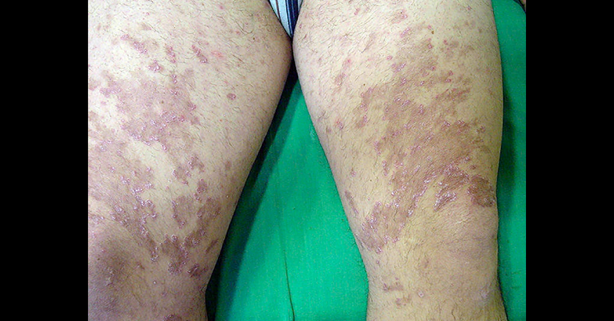 Identify This Rare Derma Condition