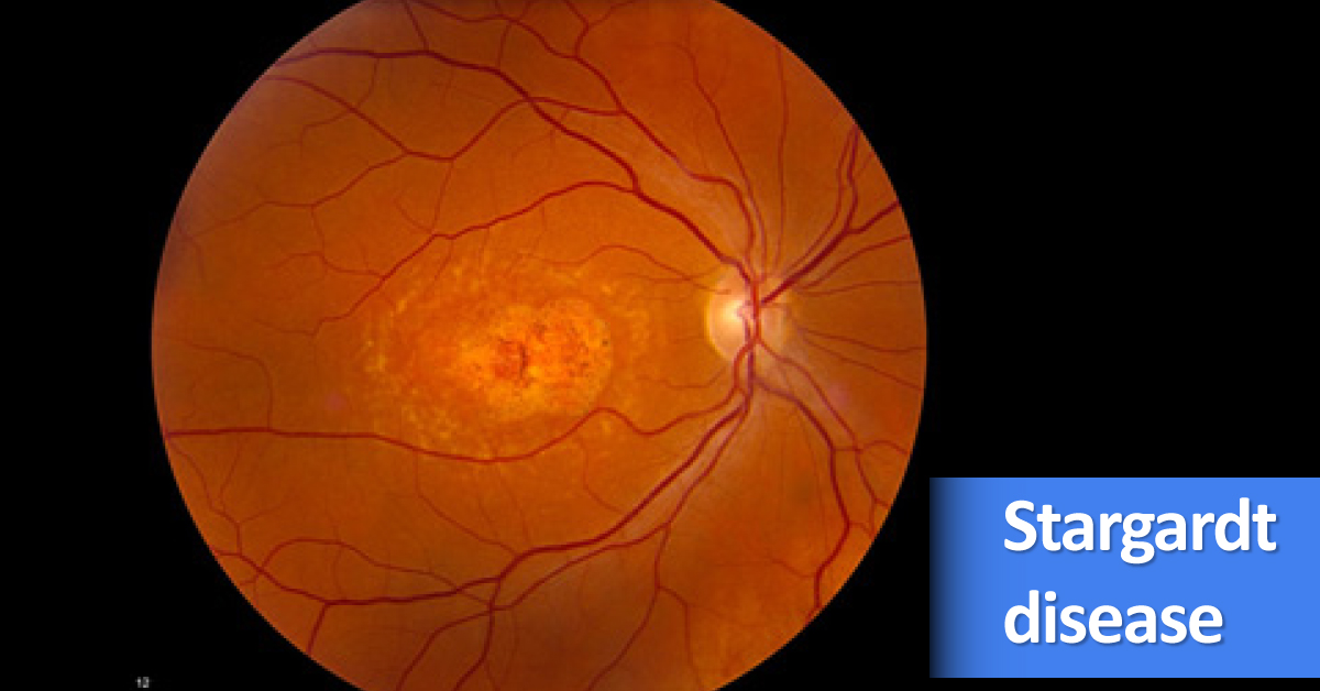 Stargardt Disease, Symptoms And Treatment