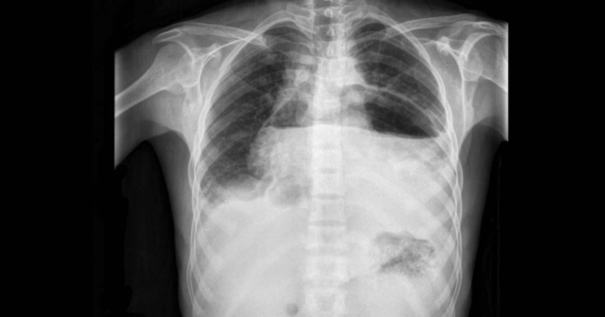 Identify The Abnormality From CT Image