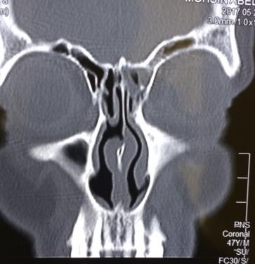 Management Of Chronic Sinusitis