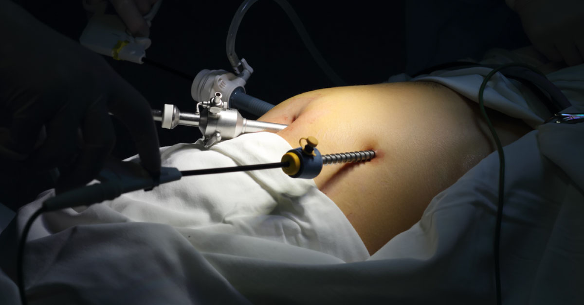 Glycemic Outcomes Following Bariatric Surgery In Diabetic Obese Patients